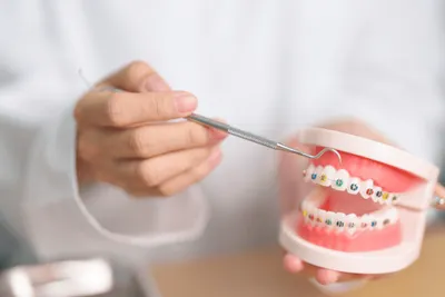 Invisalign vs traditional braces comparison