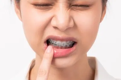 Tips for soreness after braces tightening