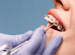 Types of braces at LifeSmile Orthodontics
